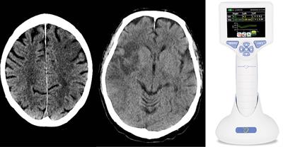 Influence of Strategic Cortical Infarctions on Pupillary Function